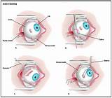 Detached Retina Recovery Time Images