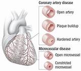 What Can Cause Coronary Artery Disease Photos