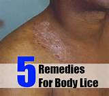 Sea Lice Home Remedies Pictures