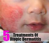 Home Remedies Atopic Dermatitis Images