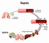Blood Sepsis In Cancer Patients Pictures