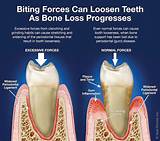 Can Tooth Implant Cause Sinus Problems