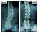 Crooked Spine Chiropractic Treatment Pictures