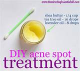 Best Essential Oil For Acne Spot Treatment
