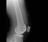 Makoplasty Hip Replacement Recovery Time Images