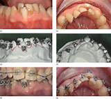 Tooth Extraction For Orthodontic Treatment Images