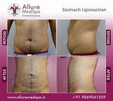 Belly Fat Laser Treatment Cost Images