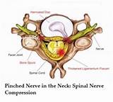 Chiropractic Treatment For Pinched Nerve In Neck Photos