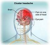 Pictures of Treatment For Chronic Cluster Headaches