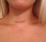 Recovery After Thyroidectomy Photos