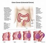 Colon Cancer Gas