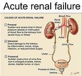Acute Renal Failure Treatment