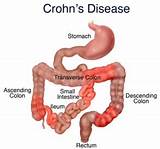 How To Control Crohn S Disease Images
