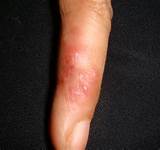 Photos of Herpetic Whitlow Home Remedies