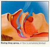 Images of Central Sleep Apnea Home Remedies