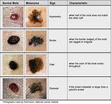When To Get Moles Checked By Doctor Pictures
