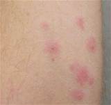 Pictures of Hay Mite Bites Treatment