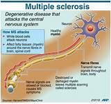 Multiple Sclerosis Balance Pictures