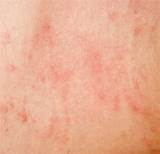 Eczema In Elbow Crease Treatment