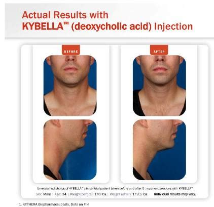 Pictures of Kybella Injections Side Effects