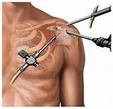 Shoulder Joint Replacement Surgery Recovery Pictures