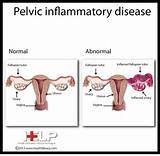Home Remedies Pelvic Inflammatory Disease Pictures