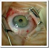 Lasik Eye Surgery After Radial Keratotomy Photos