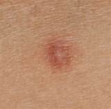 Pictures of Benign Skin Cancer Treatment