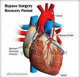Pictures of Recovery After Heart Bypass Surgery