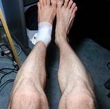 Photos of Muscle Atrophy Recovery