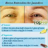 Images of Jaundice Symptoms And Treatment