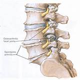 Images of Djd Spine Treatment
