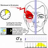 Rebound Headache Treatment Guidelines Photos