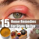 Photos of An Eye Stye Home Remedies