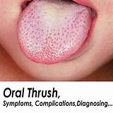 Natural Treatment For Thrush On Tongue