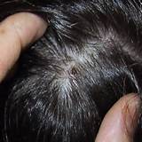 Dry Scalp Patches Home Remedies Pictures