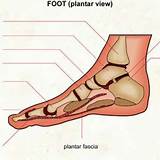 Images of Does Ice Help With Plantar Fasciitis