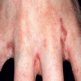 Scabies Home Remedies For Babies Pictures