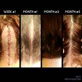 Chiari Malformation Surgery Recovery Pictures