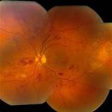 Pictures of Branch Retinal Vein Occlusion Mayo Clinic