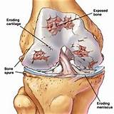 Pictures of Exercise Programs For Knee Arthritis