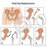 Partial Hip Replacement Recovery Time Elderly Photos