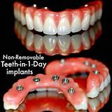 Images of Cunning Dental Implants