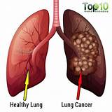 Advanced Lung Disease Symptoms
