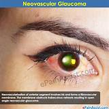 Neovascular Glaucoma Treatment Photos