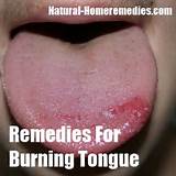 Home Remedies For Burning Tongue Photos