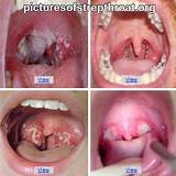 Images of Group C Strep Throat Treatment