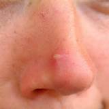 Pictures of Pimple And Dark Spot Removal