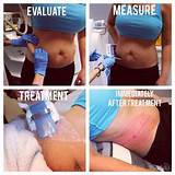 How Much Is A Coolsculpting Treatment Pictures