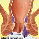 Images of How Do Doctors Remove Hemorrhoids